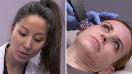 Dr Killeen Gets Rid Of Vagina Neck With MicroNeedling E Online