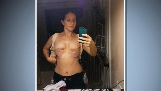 LA woman left with 'sideshow' boobs after her 32DDD implants ruptured