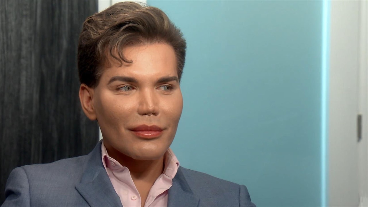 Botched Patient Rodrigo Alves Learns His Nose Could 