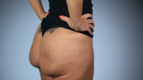 Woman who can FLIP butt implants after botched surgery on the video that  made her famous