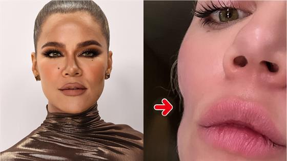 Khloe Kardashian looks totally different with huge pout and tiny